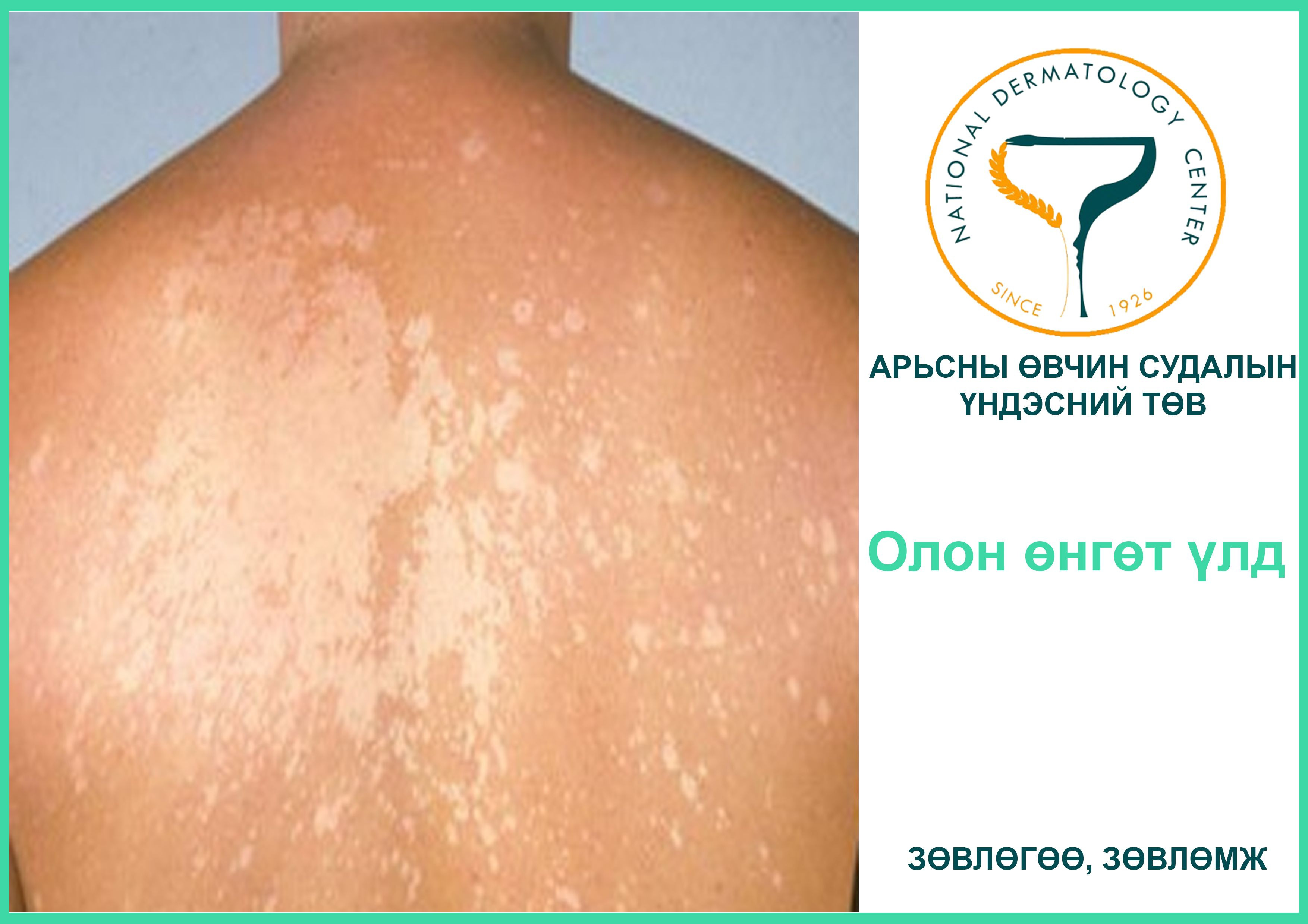 Олон өнгөт үлд гэж юу вэ?