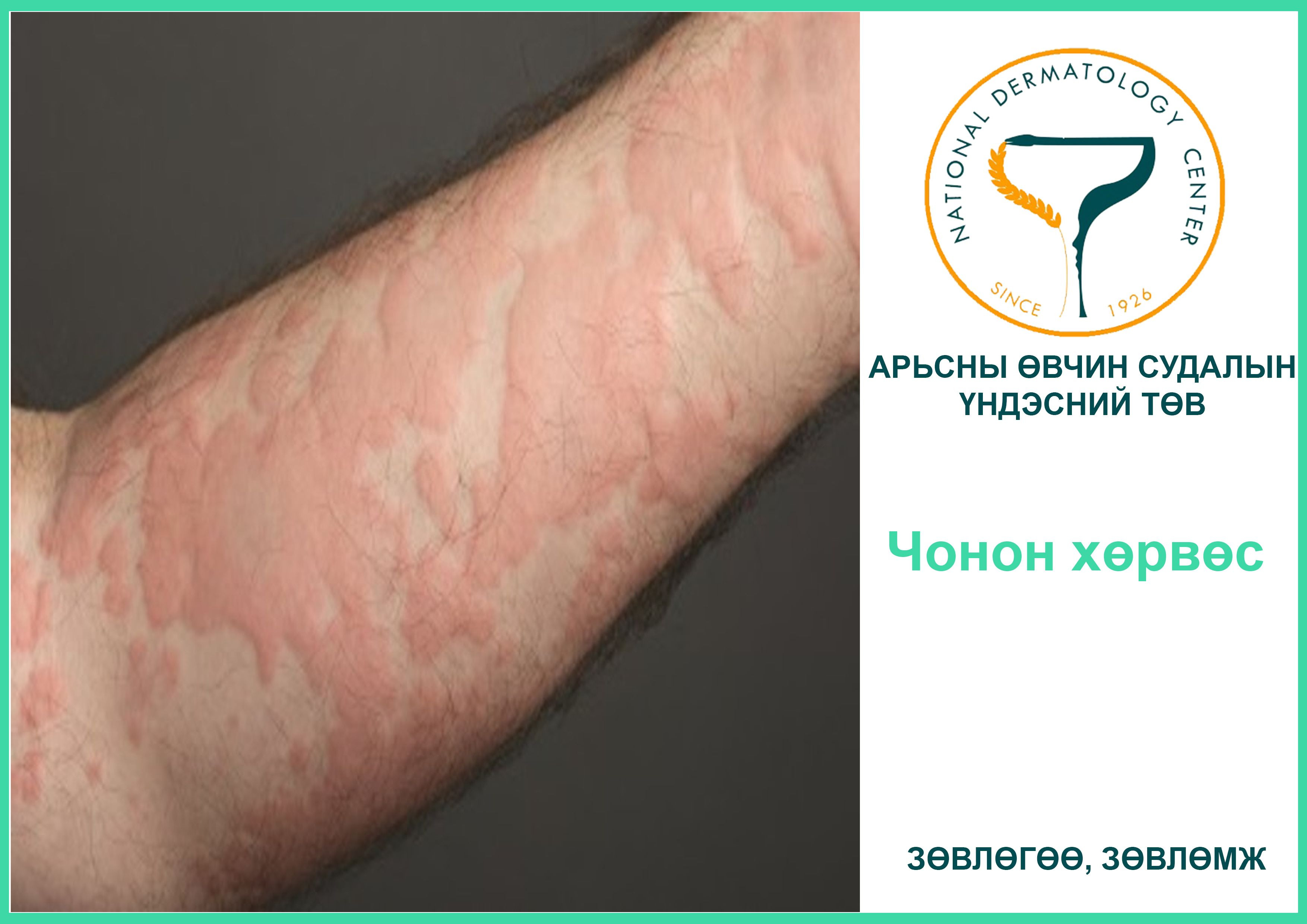 Чонон хөрвөс өвчний урьдчилан сэргийлэлт