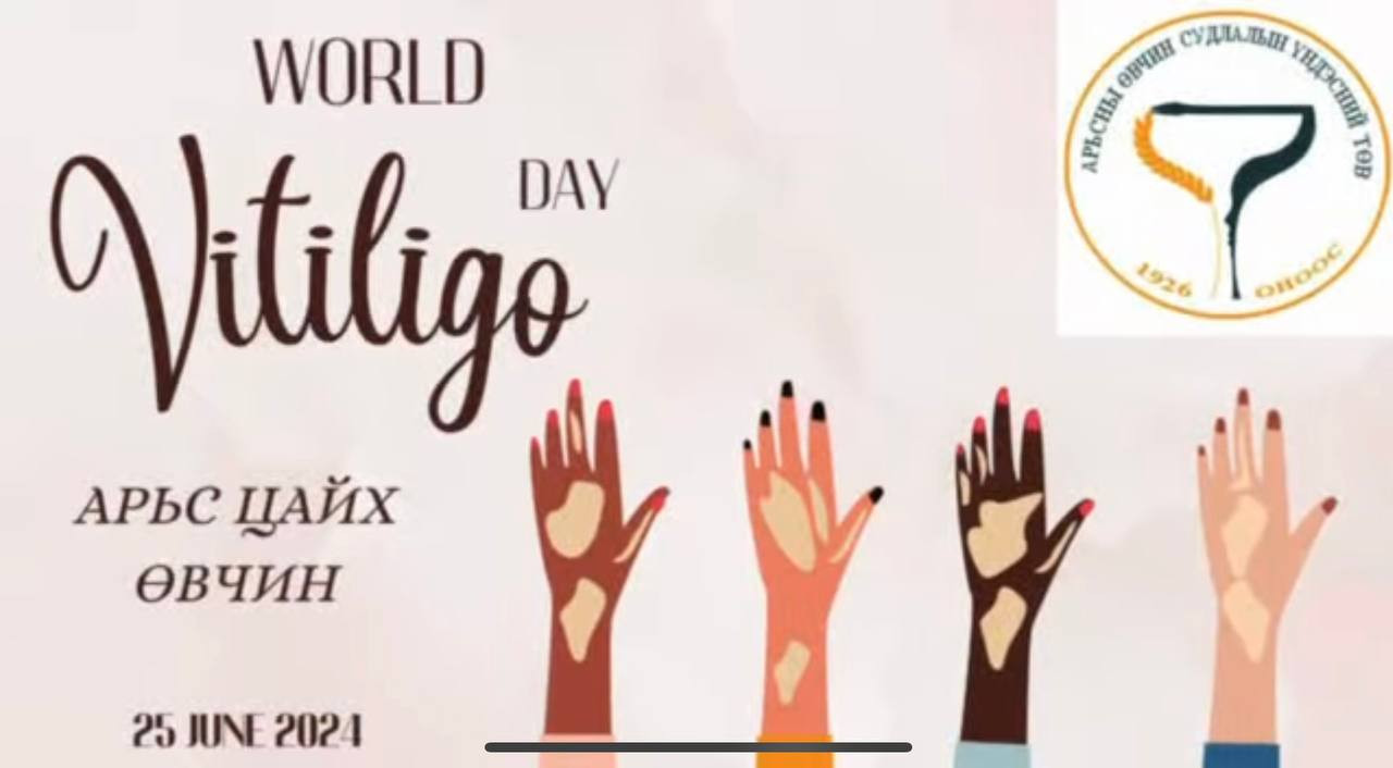 👩‍⚕️ЭМЧ ЗӨВЛӨЖ БАЙНА👇👇👇: №6 АӨСҮТ-ийн ЭГЗНСТасгийн их эмч И.Мөнхзаяа "Арьс цайх” өвчний талаар мэдээлэл хүргэж байна.